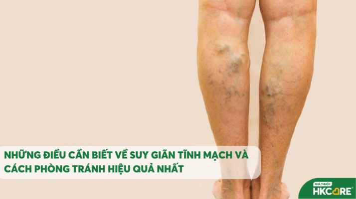 Những điều cần biết về suy giãn tĩnh mạch để phòng tránh