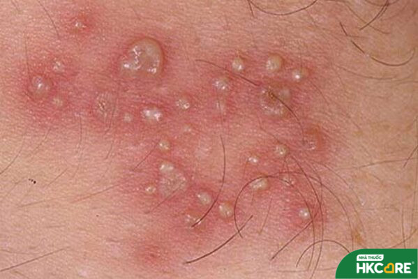 Hành động ngay_ Tìm hiểu cách sống khỏe mạnh và giảm rủi ro Polyp cổ tử cung