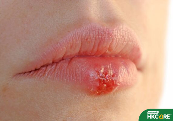 Bệnh Herpes truyền nhiễm với nhiều biến chứng nguy hiểm nếu không được kiểm soát