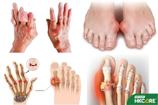 Bật mí phương pháp phòng ngừa bệnh gout đơn giản, hiệu quả cao