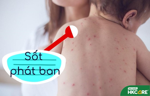 Nguyên nhân và 3  cách giúp sốt phát ban nhanh khỏi nhất